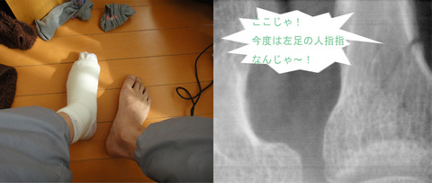 左足骨折_edited-1.jpg
